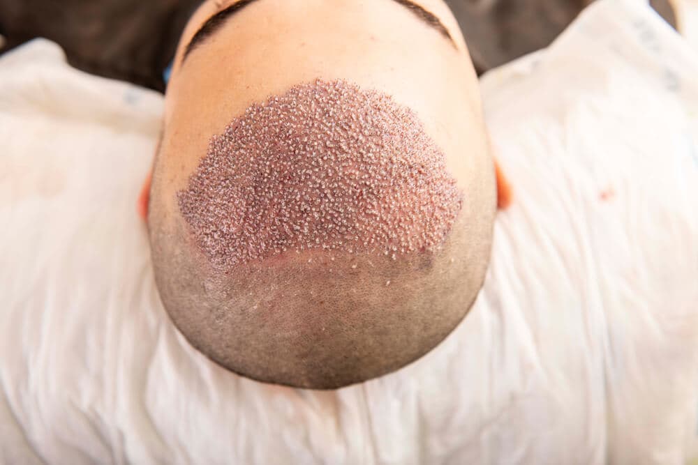 Hair transplant Turkey: Get Back Your Natural Hair